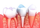 Dlaczego warto zdecydować się na implanty zębowe?